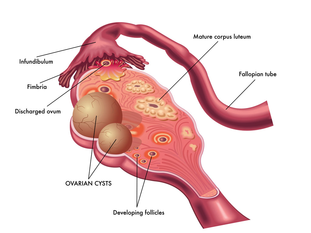 Missed Period And Ovarian Cyst: Unraveling The Connection