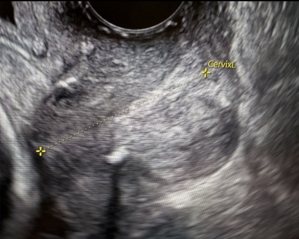 Transvaginal ultrasound showing cervical length measurement after cerclage placement